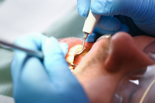 Best Emergency Dentist for Knocked-Out Tooth in Frisco, TX